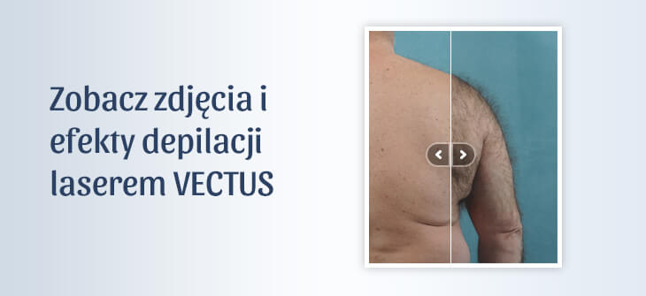 Zdjęcia efekty depilacji